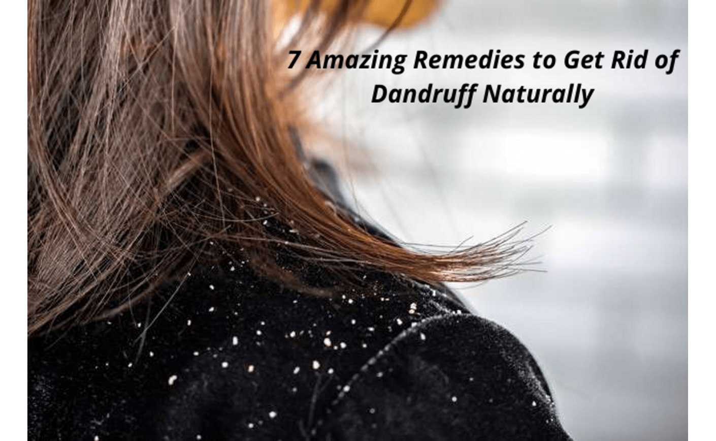 7 Amazing Remedies to Get Rid of Dandruff Naturally      