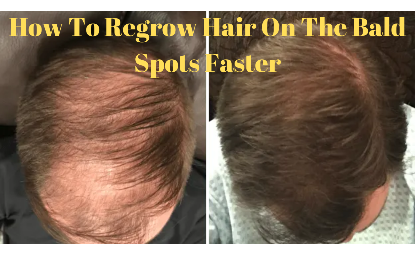 How To Regrow Hair On The Bald Spots Faster?